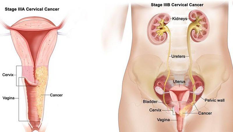 Ảnh 1 của Ung thư tử cung